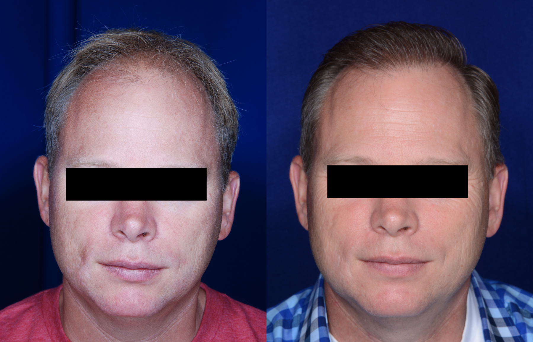 NeoGraft Before and After photo by Dr. Ronan in Danville California