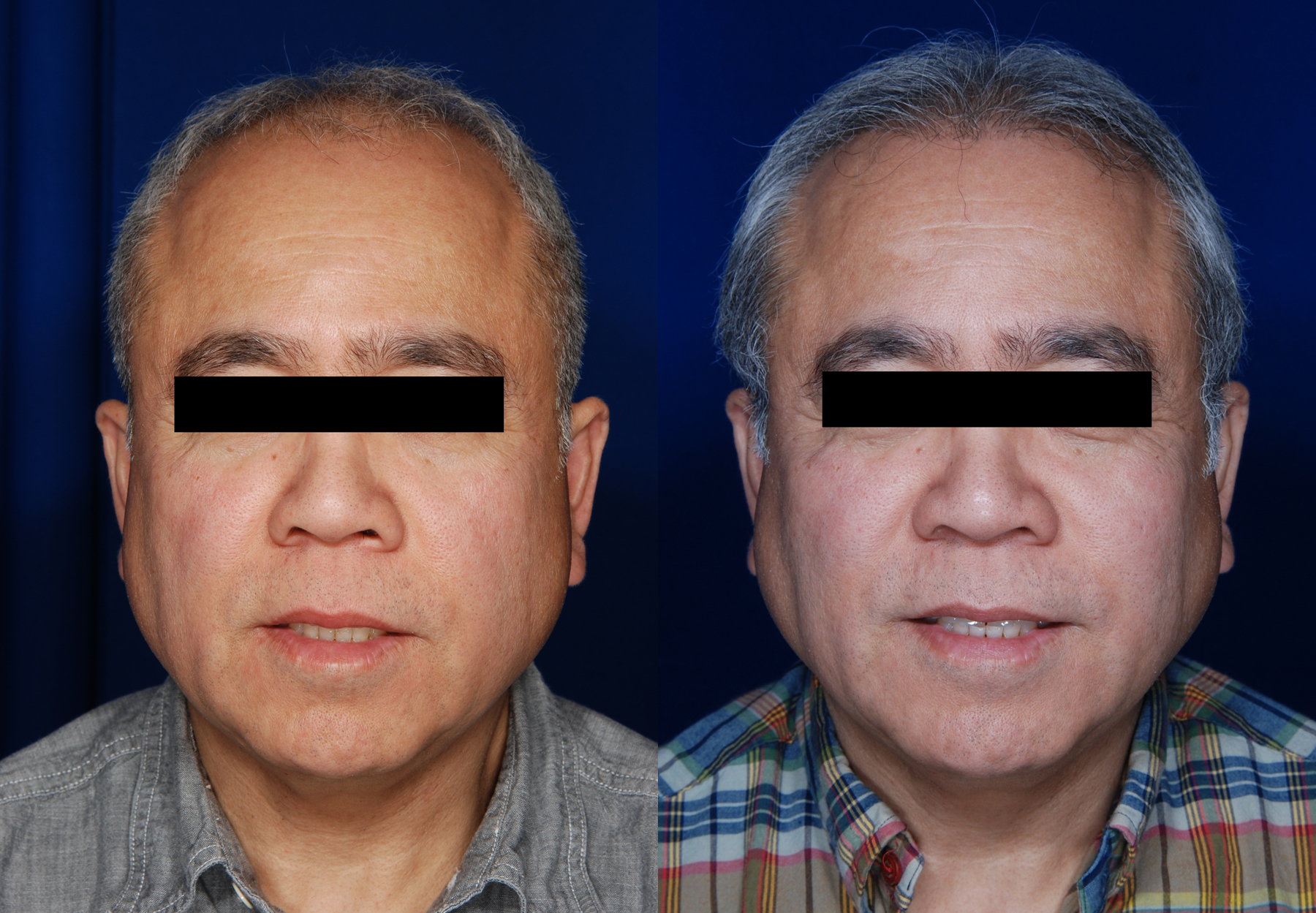 NeoGraft Before and After photo by Dr. Ronan in Danville California