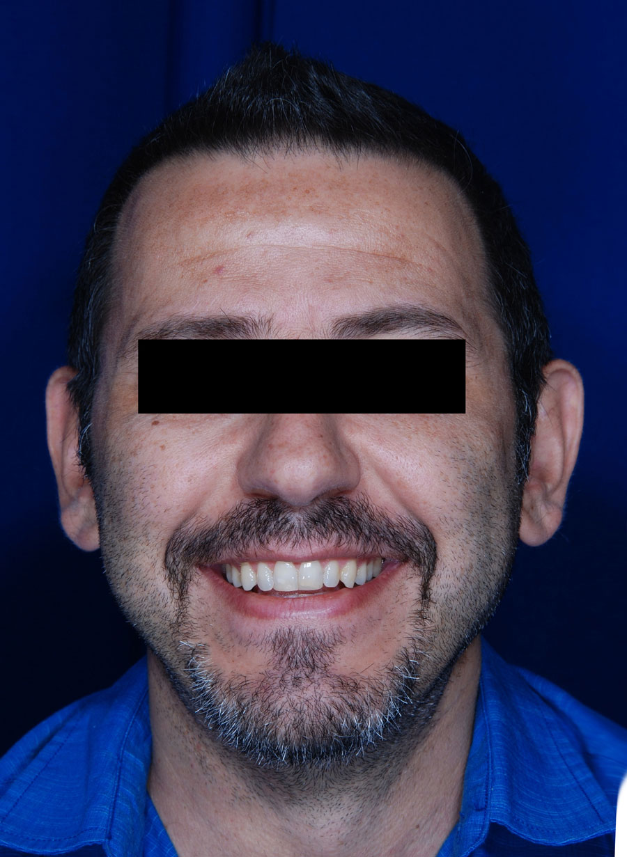 NeoGraft After photo by Dr. Ronan in Danville California