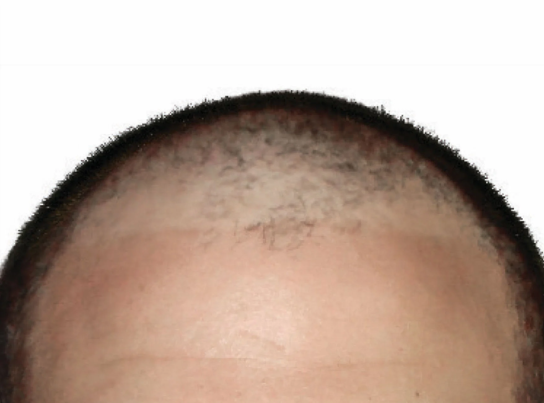 artas-before