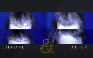 Before And After Male Hair Restoration